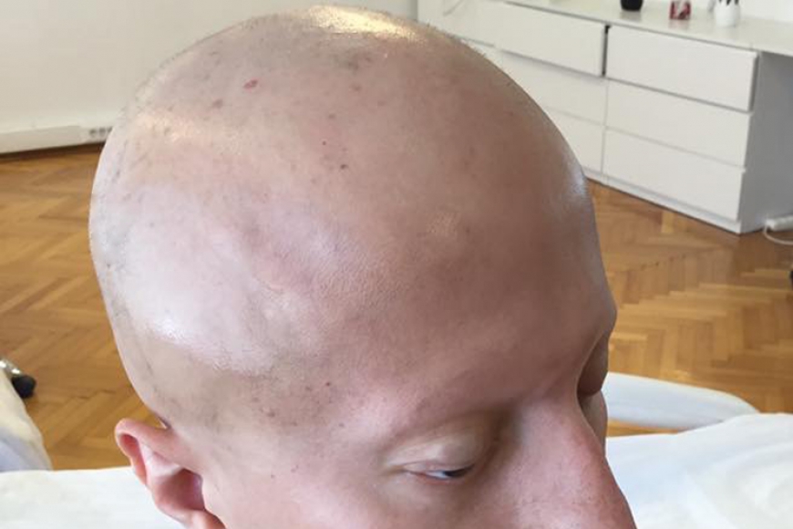 Alopesi Hastaligi Nedir Sevgi Onel Guzellik Kursu